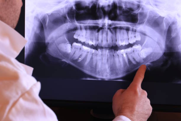 Best Dentist for Tooth Abscess  in Union Point, GA